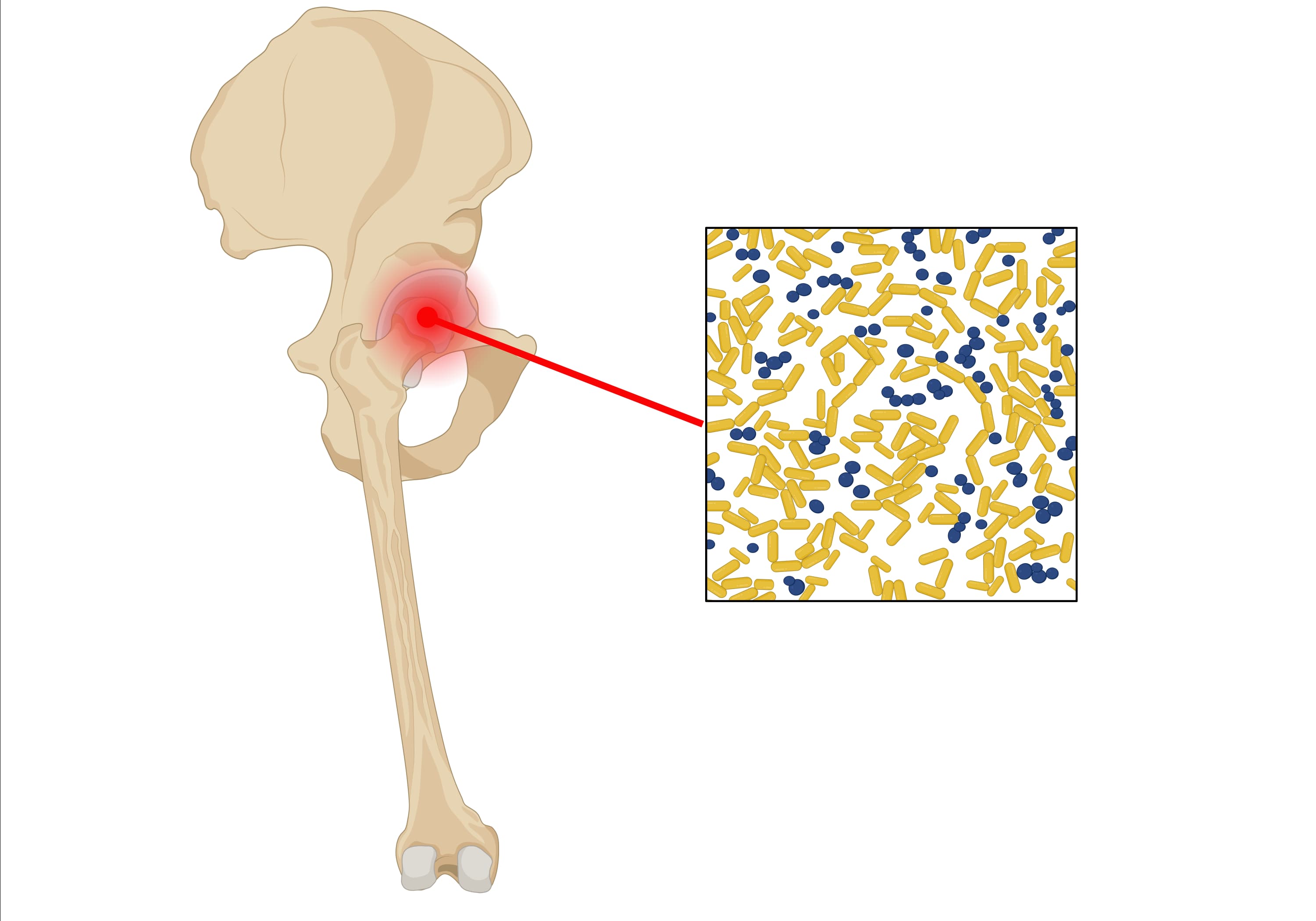 髋关节第二张 image